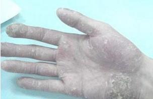 冬季牛皮癣护理要小心