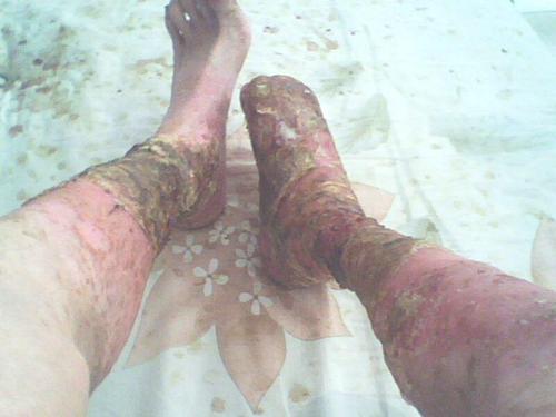 对于牛皮癣你清楚多少