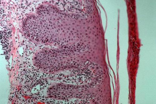 患者如何才能战胜牛皮癣