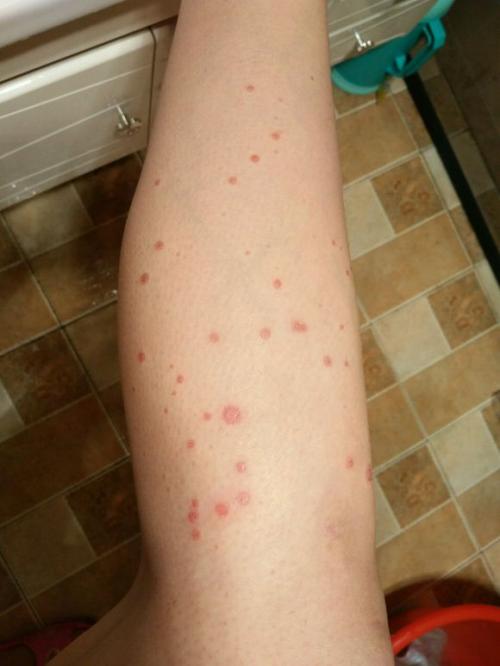 情绪对于牛皮癣的危害