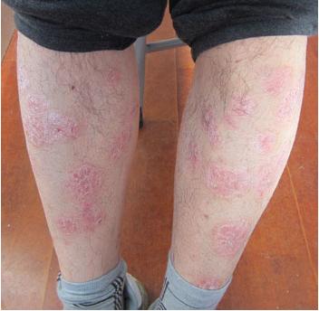 牛皮癣患者为啥不使用消炎药