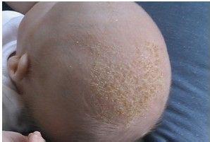 如何区分头部牛皮癣与脂溢性皮炎
