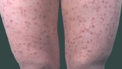 广州省红皮病型牛皮癣患者的治疗