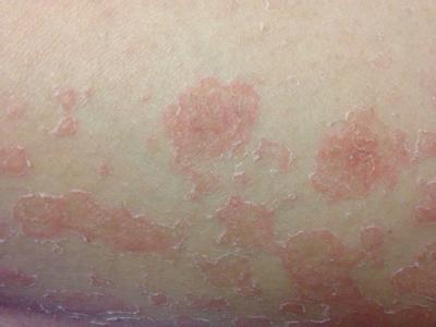 寻常型牛皮癣的病症