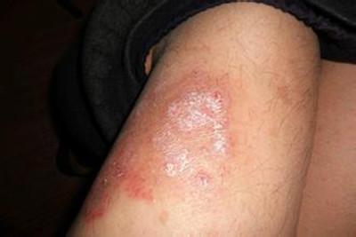 在广东牛皮鲜怎样治疗效果比较好