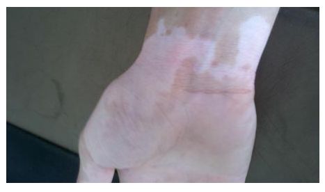 银屑病患者长跑前要注意这些