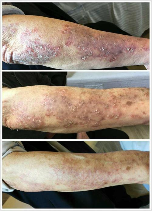 银屑病应该如何治疗