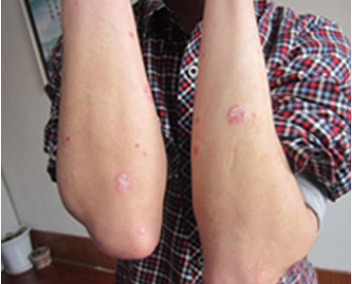 专家解答:手部牛皮癣的典型症状 专家解答:手部牛皮癣的典型症状