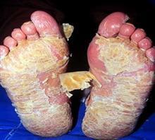 和广州医生谈谈关于牛皮癣的扩散问题 和广州医生谈谈关于牛皮癣的扩散问题