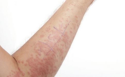 银屑病患者总是脱屑该如何是好