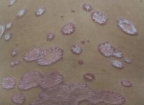 牛皮癣患者吃药