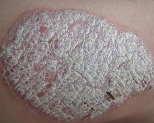 经常容易复发的牛皮鲜饮食上应该如何进行预防 经常容易复发的牛皮鲜饮食上应该如何进行预防