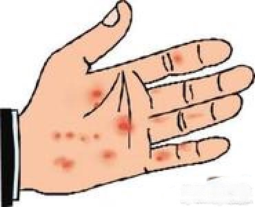 广州专业医生提醒患者朋友一定要重视牛皮癣的正规治疗 广州专业医生提醒患者朋友一定要重视牛皮癣的正规治疗